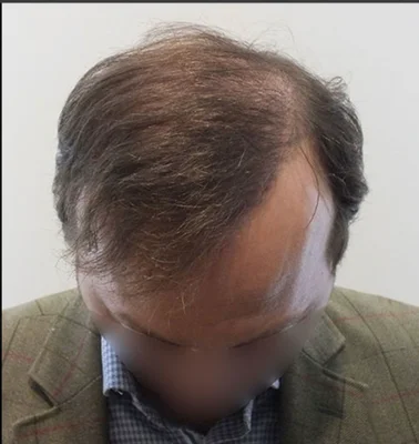 Hair Transplant - After