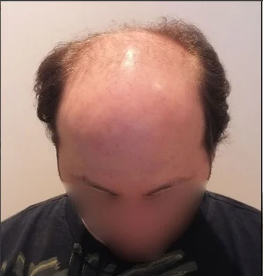 Hair Transplant - Before
