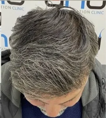 Hair Transplant - After