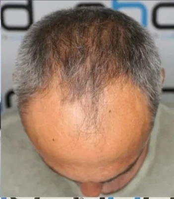 Hair Transplant - Before