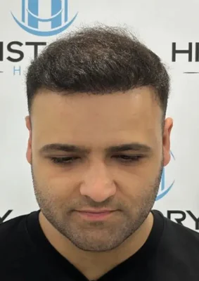 Hair Transplant - After