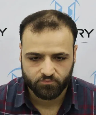 Hair Transplant - Before